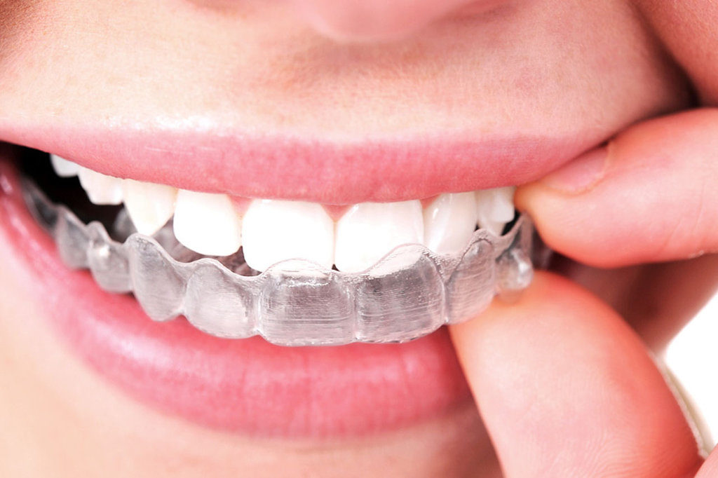 Person inserting clear orthodontic aligner tray into upper teeth for straightening treatment.