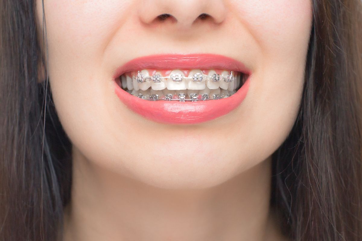 Top 5 Tips Before Orthodontic Treatment
