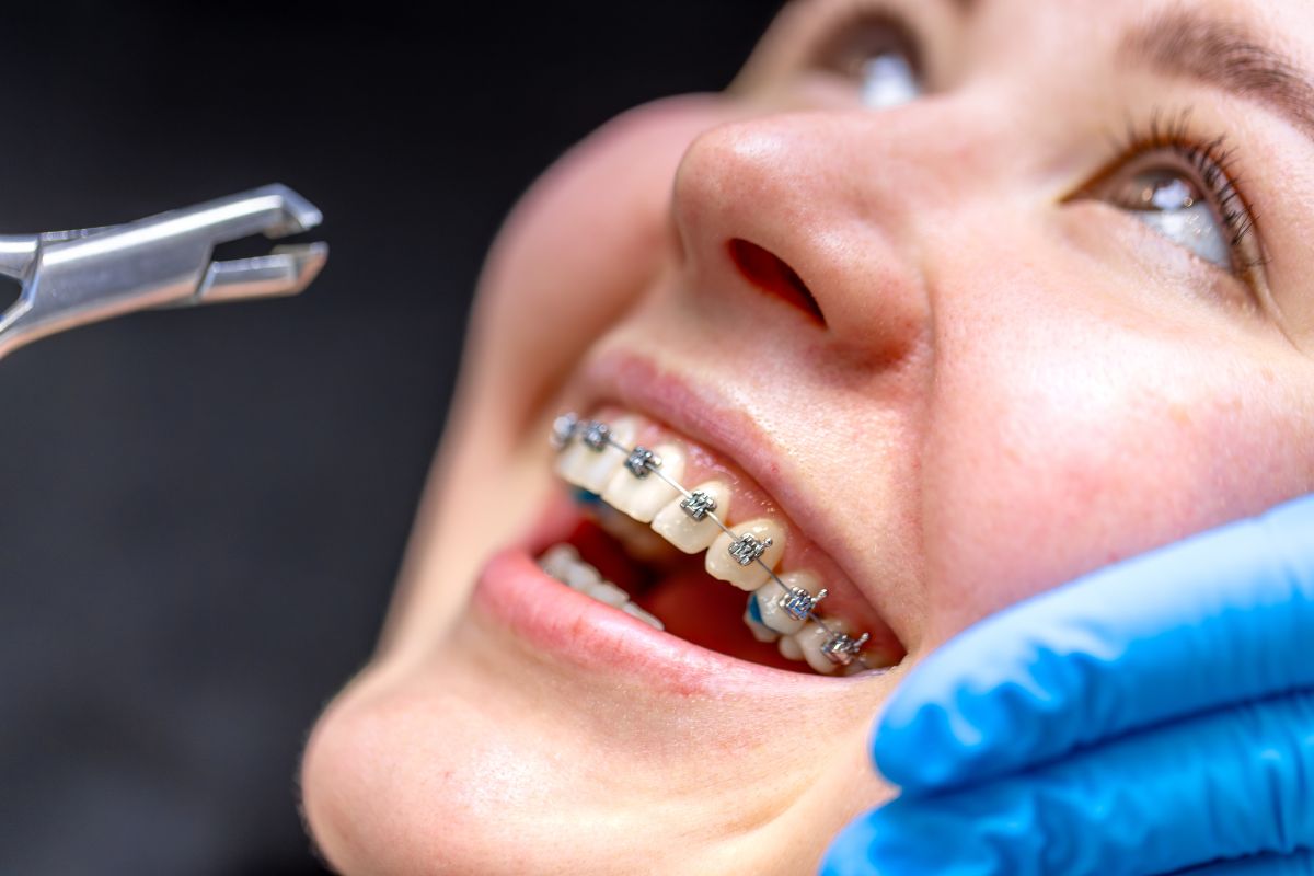 How Long Will You Need to Wear Braces