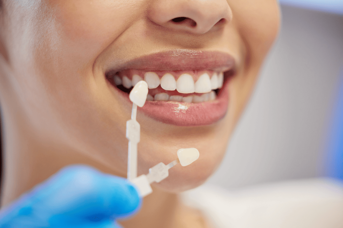 veneers in Oxford