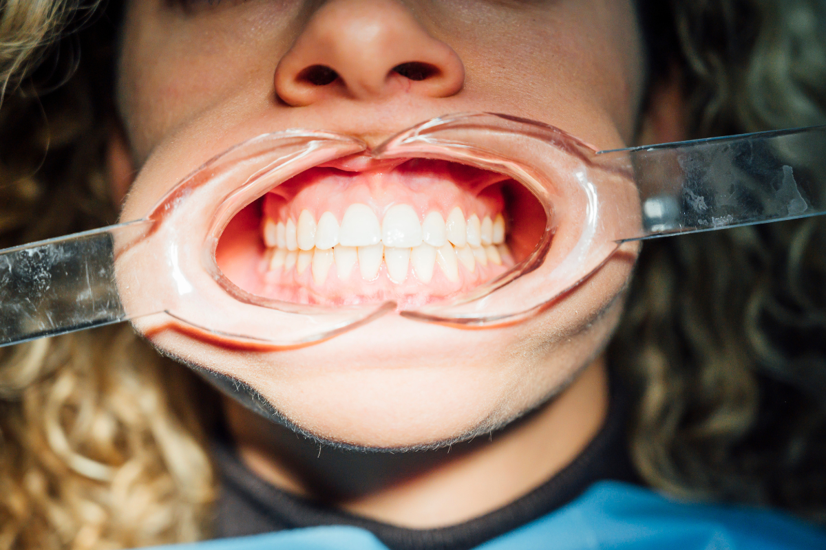 teeth whitening Oxford