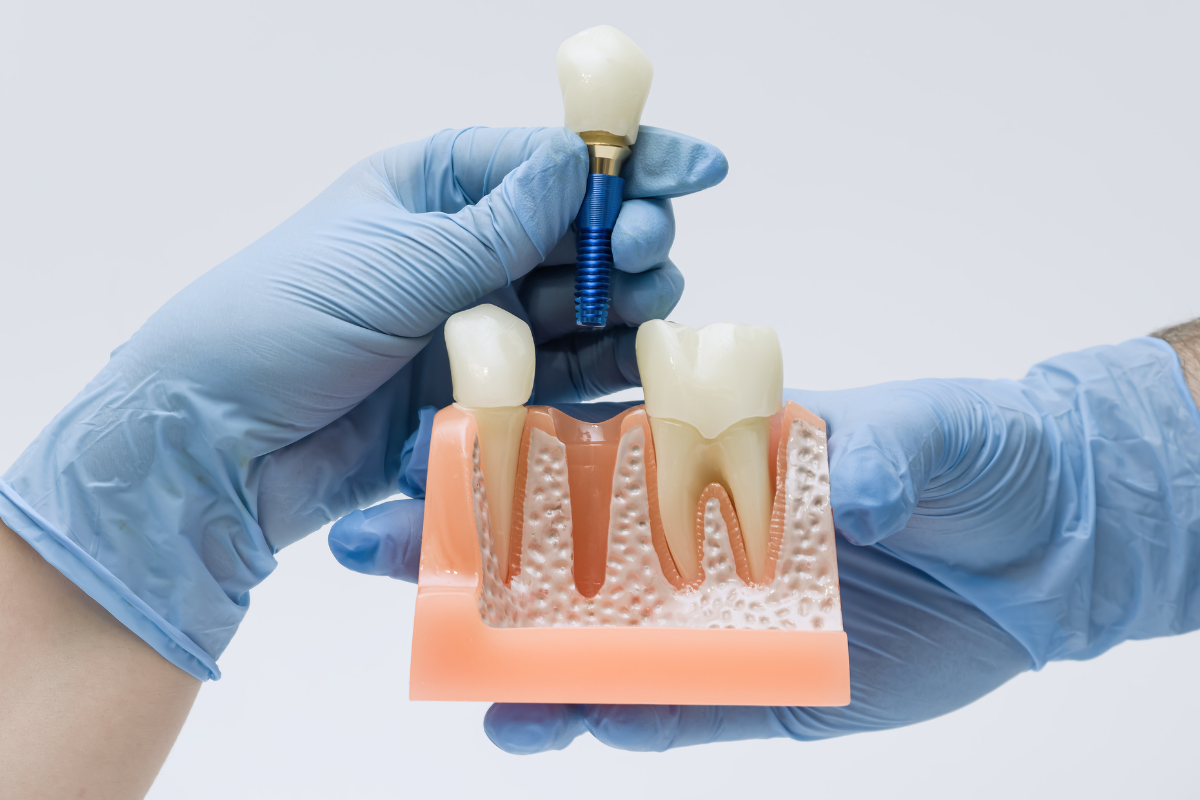 Dental implants oxford